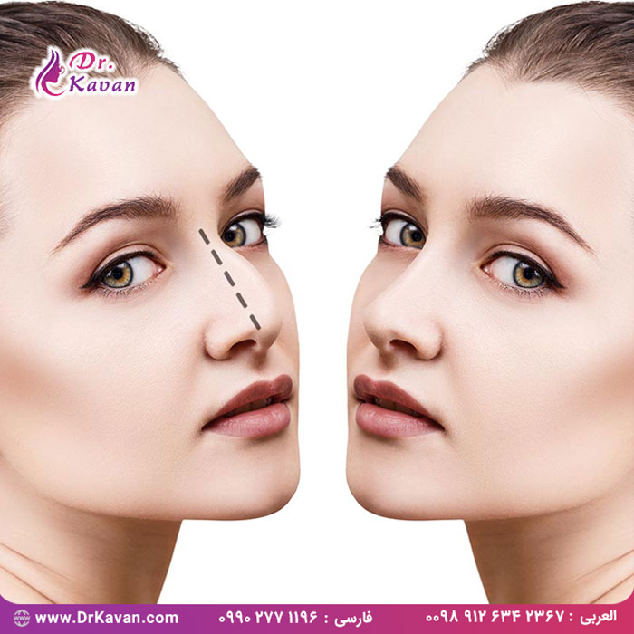 جراحی زیبایی بینی