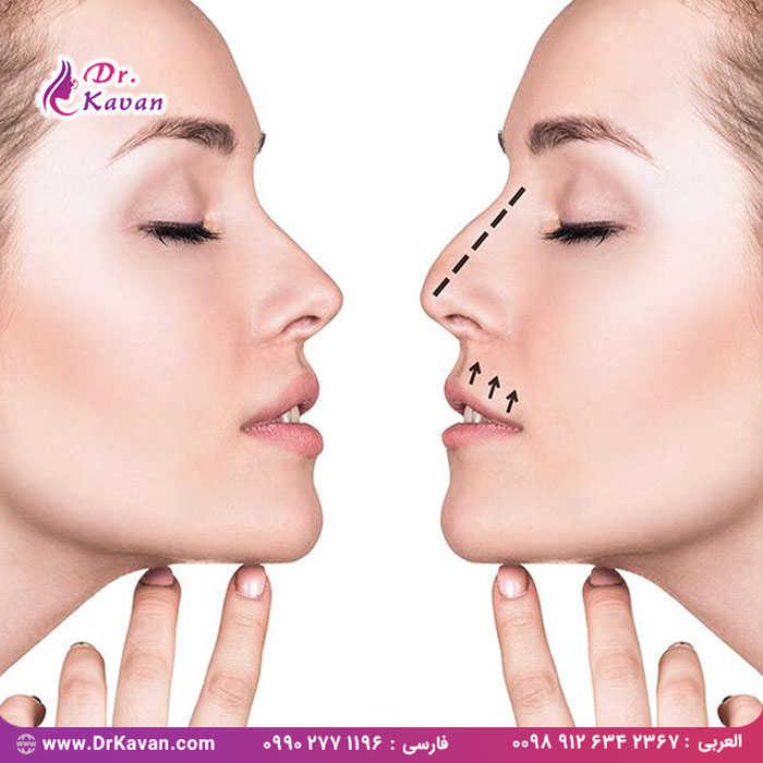جراحی بینی چگونه تمام اجزای چهره فرد را تحت تاثیر قرار می دهد؟