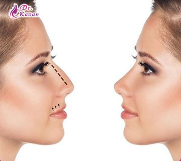 قبل و بعد از عمل بینی