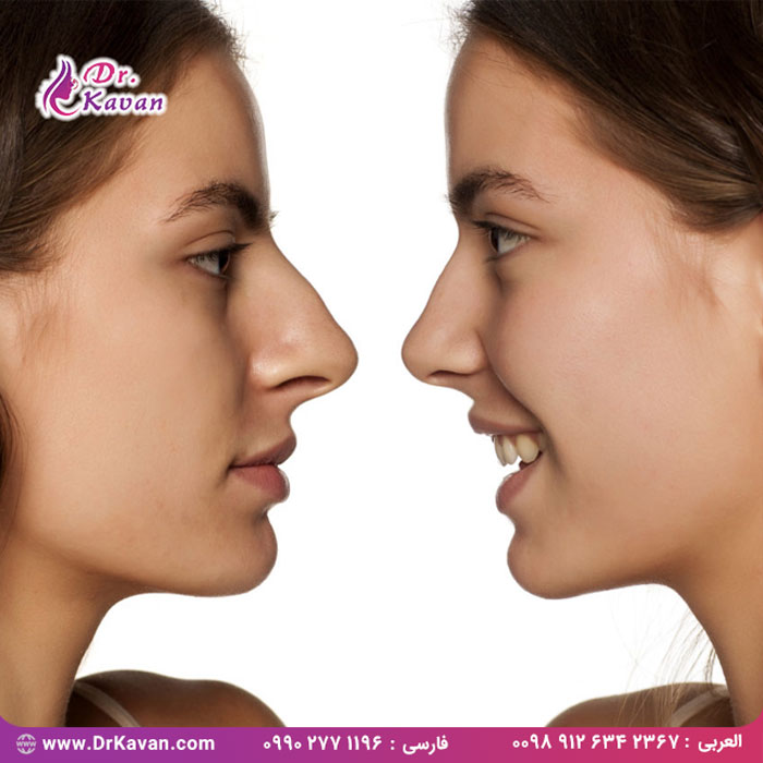 عمل بینی (رینوپلاستی) نوجوانان