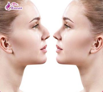 هر آنچه که باید در رابطه با جراحی بینی بدانید