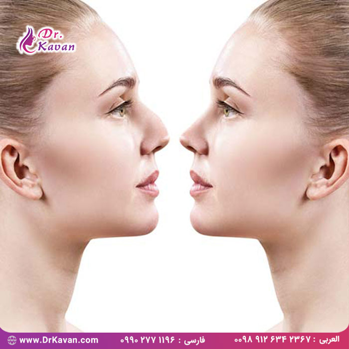 هر آنچه که باید در رابطه با جراحی بینی بدانید