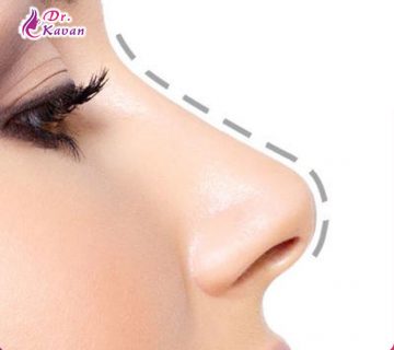 16 سوال پر تکرار درباره عمل جراحی زیبایی بینی به همراه پاسخ آن ها