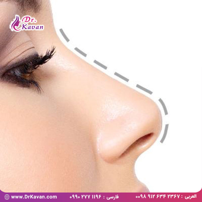 16 سوال پر تکرار درباره عمل جراحی زیبایی بینی به همراه پاسخ آن ها