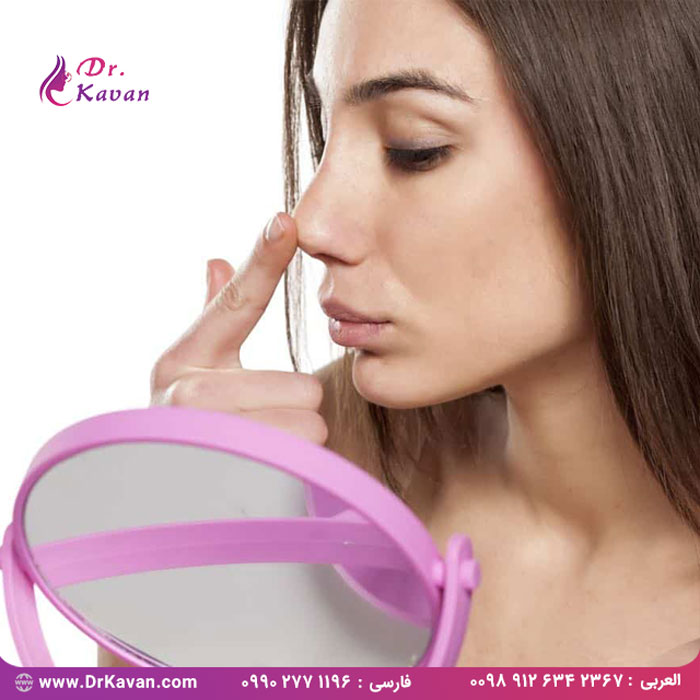 جراحی زیبایی بینی یکی از جراحی های پیچیده و ظریف پلاستیک است که نیازمند مهارت و تجربه عالی جراحان است . میزان موفقیت این جراحی در بین بیماران خود بسیار بالاست و نتایج آن در طول عمر افراد پایدار است . با این حال بیمارانی نیز هستند که برای تغییر شکل و یا اصلاح ساختار بینی به عمل جراحی مجدد فکر می کنند . دلایل مختلفی برای انجام مجدد عمل جراحی زیبایی بینی وجود دارد – شاید به اندازه همان مقداد دلیلی که برای بار اول این جراحی را انجام می دهند – سه دلیل عمده جرحی مجدد بینی در ادامه آورده شده است . در صورتی که نتیجه ی جراحی اول شما نا امید کننده بوده است ... هر فرد خواستار جراحی زیبایی بینی و پزشک جراح آن ها ، برای دستیابی به بهترین نتیجه برنامه ریزی و تلاش می کنند . با این وجود در صورتی که انتظارات بیمار پیش از جراحی به درستی فهمیده نشده باشد ، امکان این که بیمار از نتیجه جراحی راضی نباشد ، وجود دارد . در صورتی که شما انتظار تغییرات بیشتر و وسیع تری که امکان اجرای آن ها بر روی ساختار بینی شما نبوده است را داشته باشید ، ممکن است پس از اینکه پانسمان بینی خود را برداشتید از نتیجه راضی نباشید . اگر شما و پزشک جراحتان به خوبی با یکدیگر مشورت و صحبت نکرده باشید ، نتیجه ای که شما در نهایت در ذهن خود دارید در مقایسه با آنچه که در واقعیت برای شما پیش می آید ، بسیار متفاوت خواهد بود . در موارد دیگر ، جراح پلاستیک صورت ممکن است فاقد مهارت یا دانش لازم برای درست کردن آنچه که شما در ذهن خود دارید ، باشد . اشتباهات – با اینکه بسیار نادر است – اتفاق می افتند و نتیجه ی حاصل ممکن است شما را ناراحت کرده و باعث شود که حسرت گذشته را بخورید . عمل جراحی رینوپلاستی دوم اغلب در چنین شرایطی به عنوان شانس دوم برای دستیابی به بهترین نتیجه ی ممکن ، در نظر گرفته می شود . به طور معمول افراد برای بار دوم به جراح پلاستیک دیگری مراجعه می کنند تا کاری که پزشک اول نتوانست به درستی انجام دهد را برای آن ها انجام دهند ؛ برای همین در انتخاب پزشک و جراح متخصص با احتیاط و وسواس بیشتری عمل می کنند تا پزشکی را انتخاب کنند که بالاترین میزان رضایتمندی بیمارانی که برای بار دوم جراحی می کنند را در کارنامه خود داشته باشد . اگر جراحی اولیه با مشکلاتی روبرو شد ... بینی یکی از ظریف ترین و پیچیده ترین مناطق کل بدن انسان است ، به این معنی که فقط باید با تجربه ترین و ماهرترین جراحان پلاستیک صورت برای انجام هر روش جراحی زیبایی بینی انتخاب شوند. هنگامی که عمل های جراحی ای مانند جراحی بینی با عجله و یا بدون مهارت کافی جراح برنامه ریزی شوند ممکن است عوارض بعد از جراحی منجر به مراجعه دوم به میز عمل جراحی شود. برخی از این عوارض جانبی ناخواسته می تواند شامل موارد زیر باشد : • برآمدگی یا تو رفتگی در امتداد پل بینی • رشد بیش از حد بافت جای زخم • انحراف حفره های بینی • دریچه بینی فرو رفته (collapsed) • مشکلات تنفس یا سینوسی اگر اولین عمل جراحی زیبایی بینی شما روی عملکرد بینی شما تأثیر گذاشته است ، باید یک عمل جراحی زیبایی بینی برای ترمیم آسیب و یا اصلاح مسئله ، برنامه ریزی شود. جراح پلاستیک صورت خود را عاقلانه انتخاب کنید تا به شما در برنامه ریزی برای یک جراحی سریع ، ایمن و مؤثر برای رسیدن به بینی که هم از نظر زیبایی و هم از نظر عملکرد در بهترین شرایط خود باشد ، کمک کند . اگر دچار آسیب بعد از جراحی زیبایی بینی شدید ... حتی ایده آل ترین جراحی زیبایی بینی در اثر يک ضربه و صدمه به صورت و آسیب به بینی می تواند در چشم به هم زدن از بین برود . بيني شما بعد از جراحي بيني بيشتر يا کم تر نسبت به قبل از عمل ، اسيب پذير تر نخواهد شد ؛ بنابراين در بازي هاي ورزشي که احتمال برخورد و ضربه در آن وجود دارد و همچنین بازی ها و ورزش های تیمی احتیاط کنید . همان طور که پیش از اولین عمل جراحی زیبایی بینی ، بیماران به دنبال رفع آسیب ها و ترمیم آن هستند ؛ همین قصد و هدف می تواند به راحتی بعد از اولین جراحی در بیماران تکرار شود . در این حالت ، بررسی مجدد توسط جراحی که عمل شما را انجام داده بود می تواند حرکت هوشمندانه ای باشد اگر جراح شما با عمل های زیبایی ترمیمی تجربه کافی داشته باشد و بتواند به شما اطمینان دهد که نتیجه ی مورد نظر می تواند برای بار دوم نیز حاصل شود . گاهی اوقات ممکن است بیمار به جراح پلاستیک صورت دیگری که مهارت بالاتری در ترمیم آسیب دیدگی و عمل دوباره را داشته باشد .