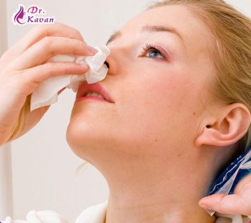 خونریزی خلفی بینی چیست؟