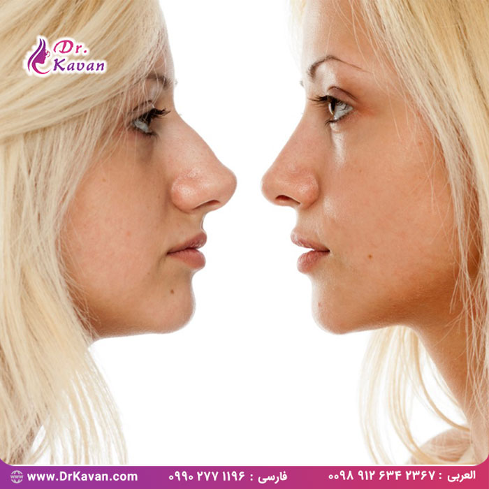 دلایل انتخاب جراحی زیبایی بینی