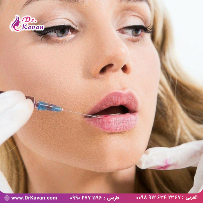 فیلر لب
