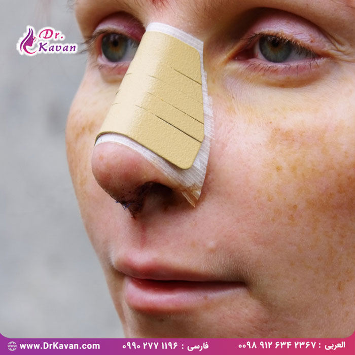 عمل شکستگی بینی