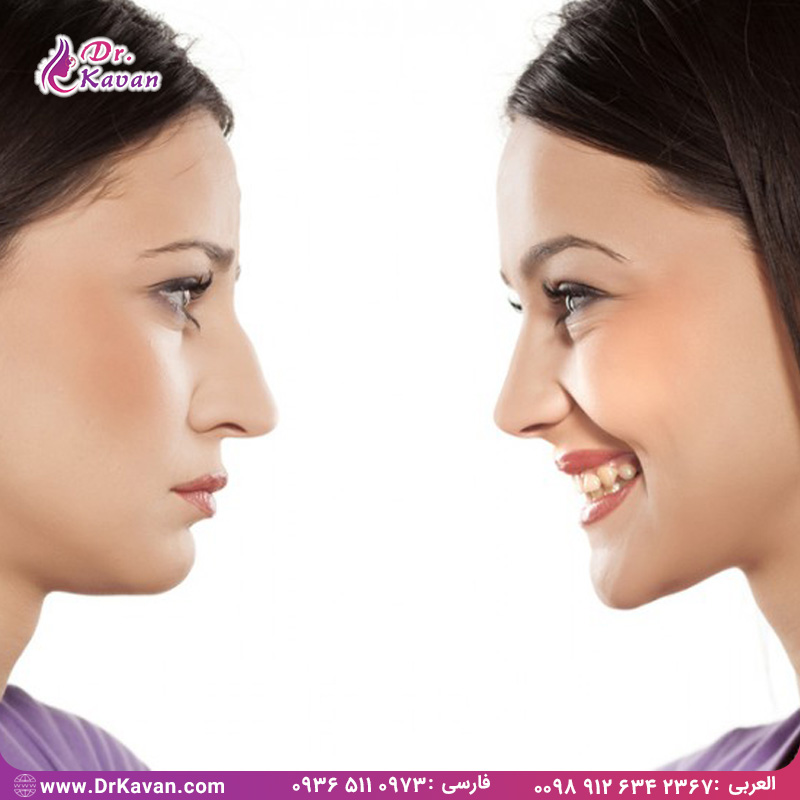 عمل بینی چگونه کیفیت زندگی را بهبود می بخشد؟