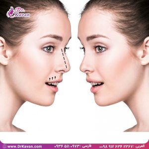 سوالات بعد از عمل بینی