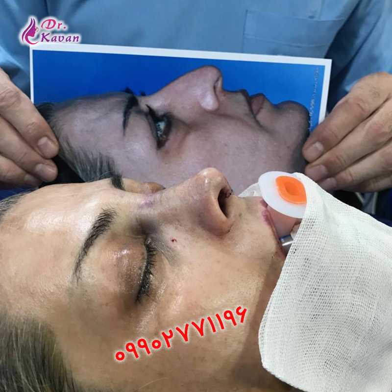 عمل بینی استخوانی