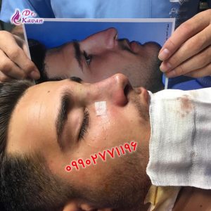 عمل بینی استخوانی