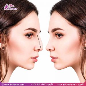 سوالات بعد از عمل بینی