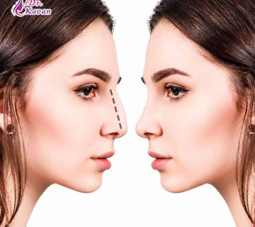 سوالات بعد از عمل بینی