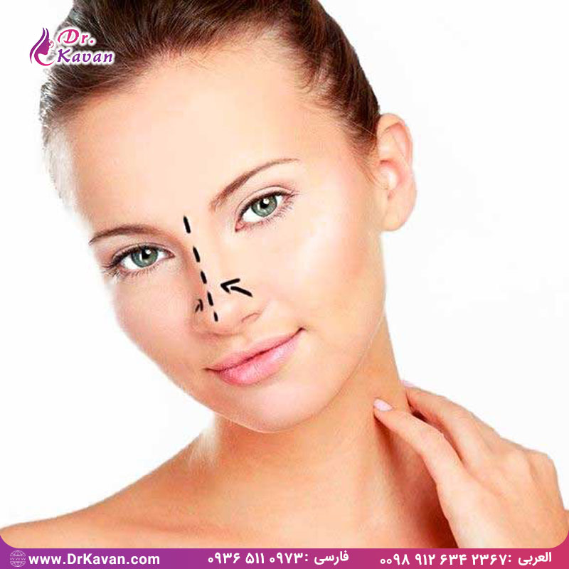 در مورد رینوپلاستی بیشتر بدانید