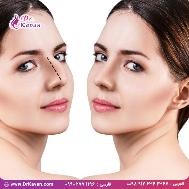 قبل و بعد از عمل بینی