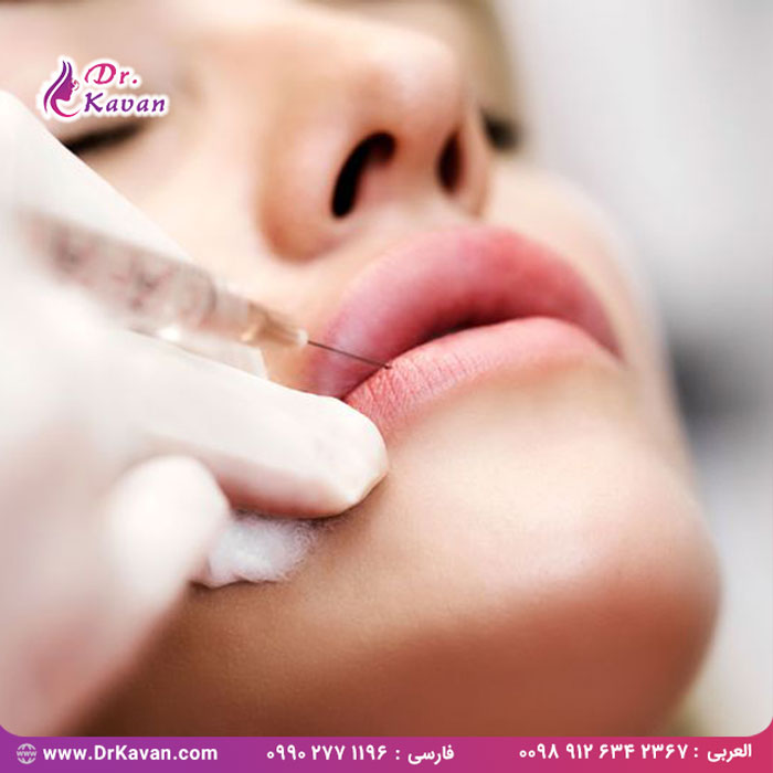 تزریق ژل لب