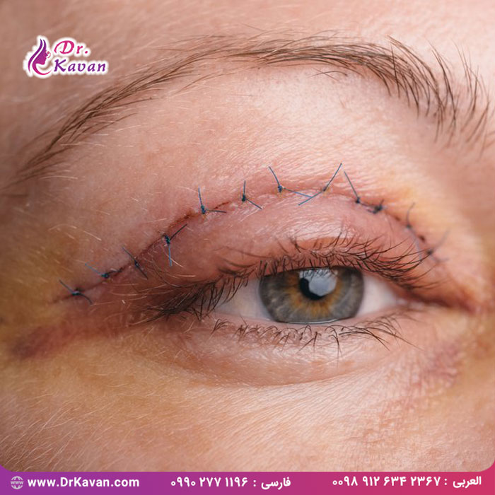 بلفاروپلاستی (جراحی پلک)