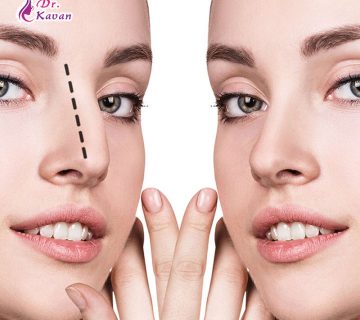 عمل بینی قوس دار