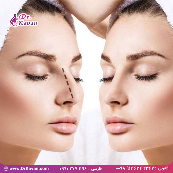 سوالات متداول در مورد عمل زیبایی بینی