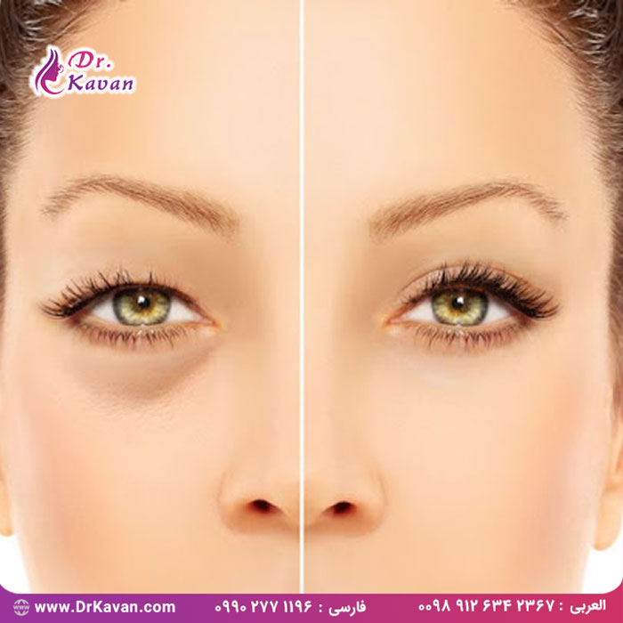 بلفاروپلاستی (جراحی پلک)