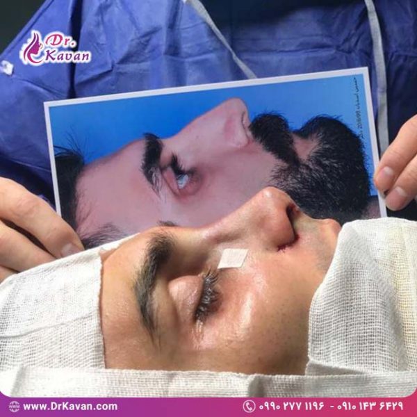 عمل زیبایی بینی