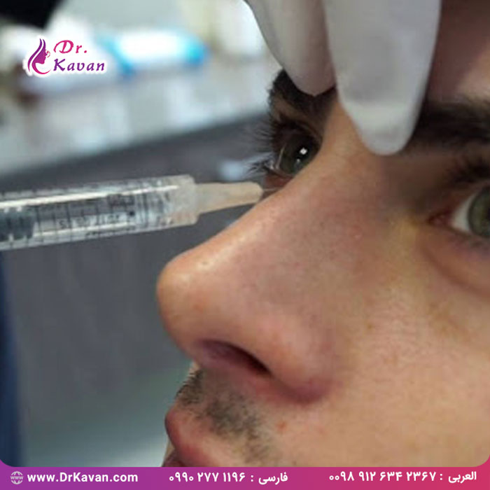 تزریق فیلر بینی