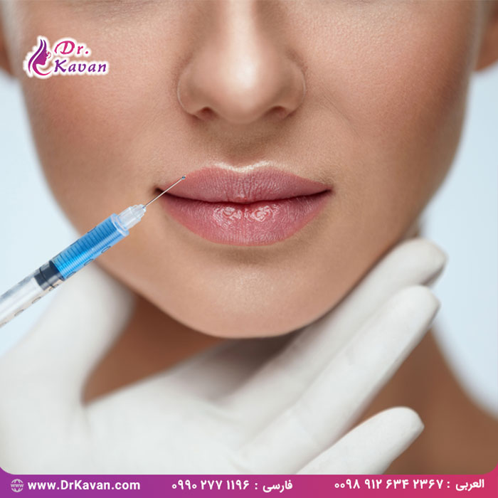 فیلر لب