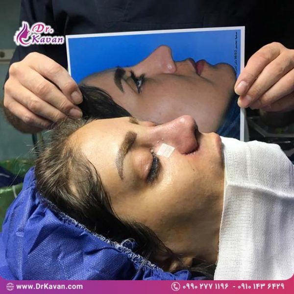 عمل زیبایی بینی