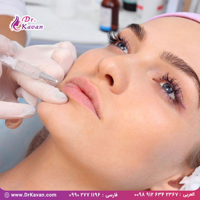 تزریق ژل لب