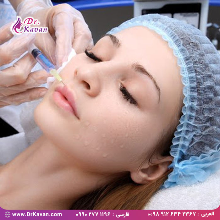 آنچه باید درباره تزریق فیلر رستیلن بدانید!