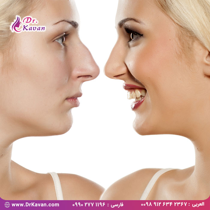 دلایل انتخاب جراحی زیبایی بینی