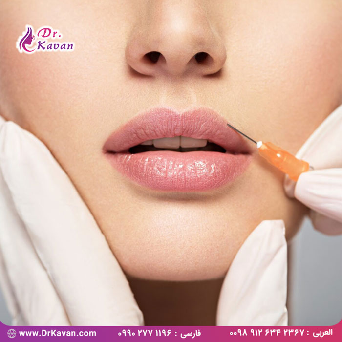 فیلر لب