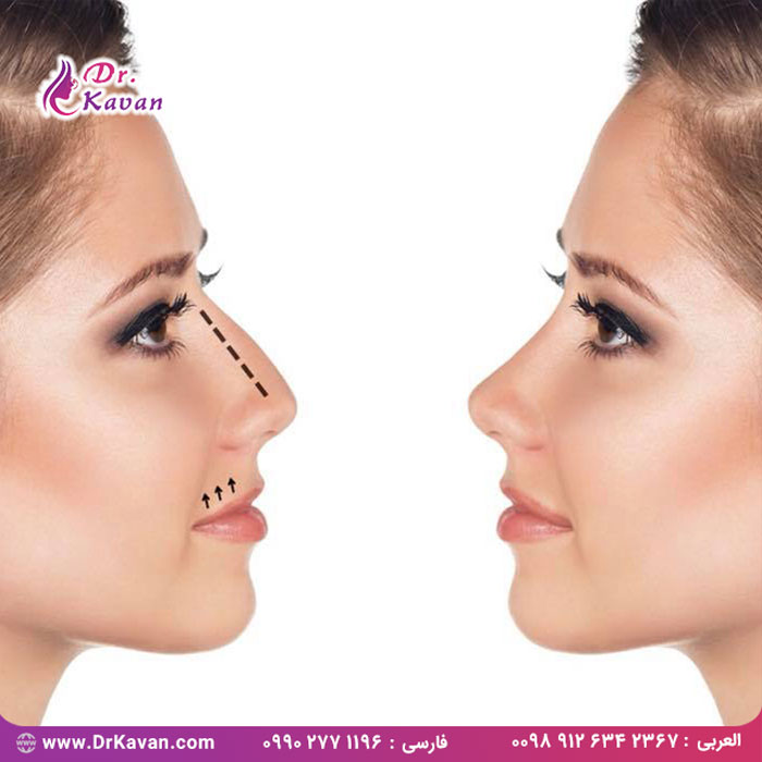 افرادی که عمل زیبایی بینی انجام داده اند