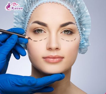 بلفاروپلاستی (جراحی پلک)