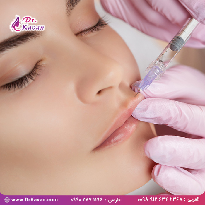 تزریق ژل لب