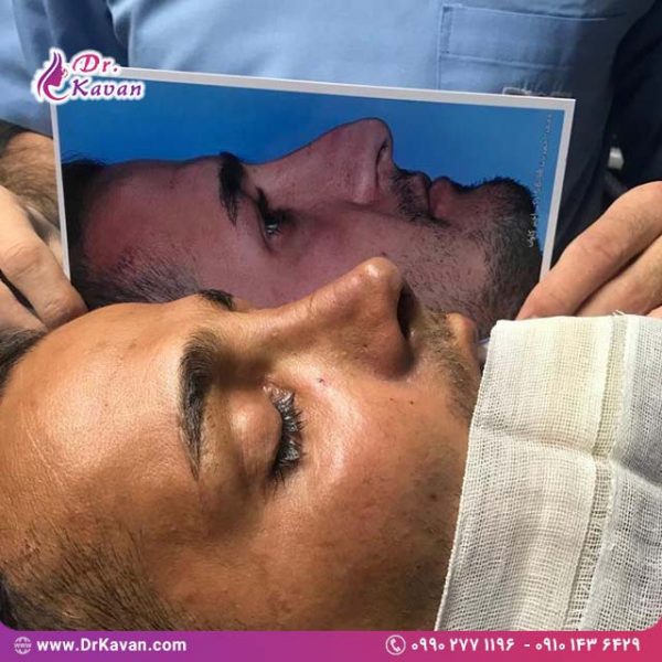 عمل زیبایی بینی