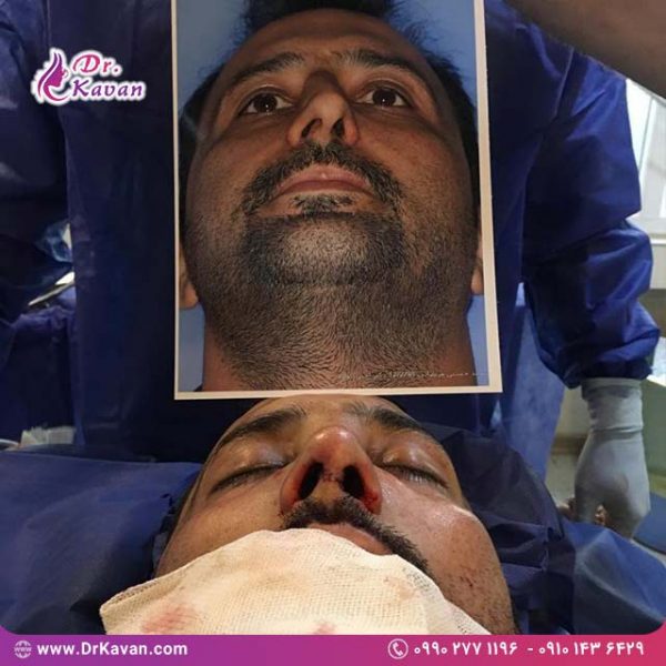 عمل زیبایی بینی