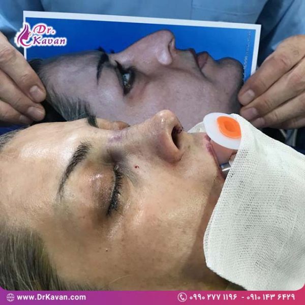 عمل زیبایی بینی