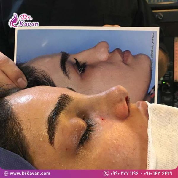 عمل زیبایی بینی