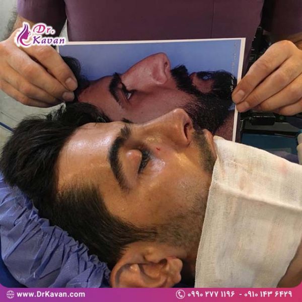 عمل زیبایی بینی