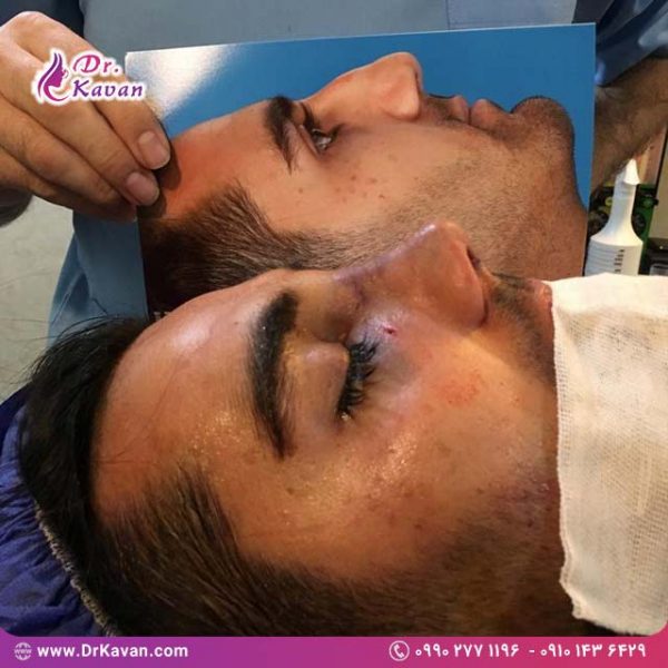 عمل زیبایی بینی