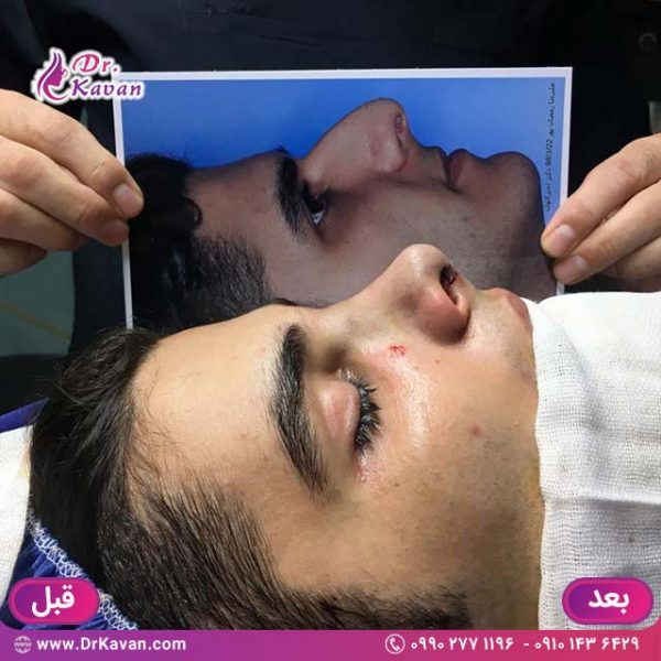 عمل زیبایی بینی