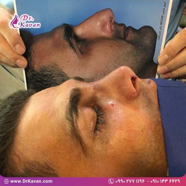 عمل زیبایی بینی