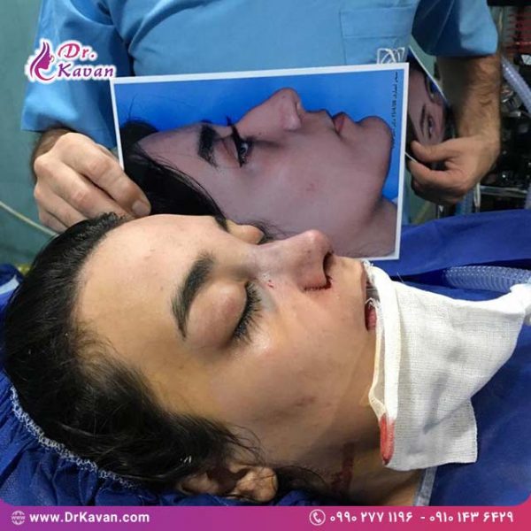 عمل زیبایی بینی