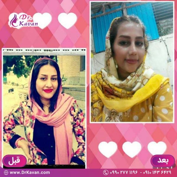 عمل زیبایی بینی