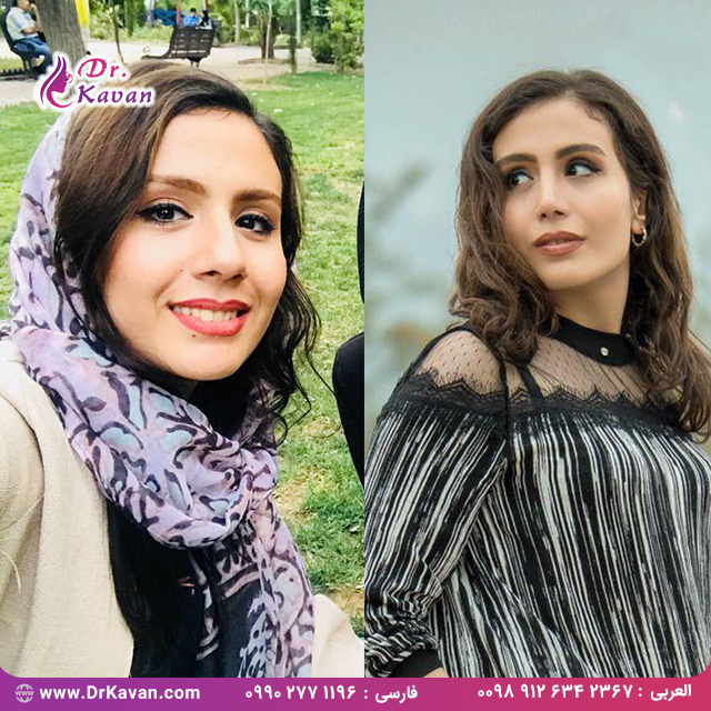 قبل و بعد عمل بینی گوشتی