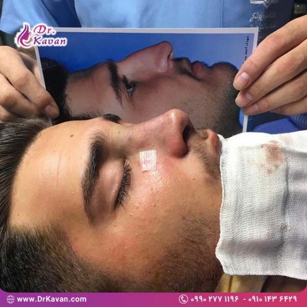 عمل زیبایی بینی