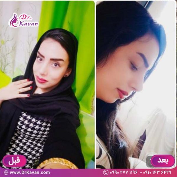 عمل زیبایی بینی